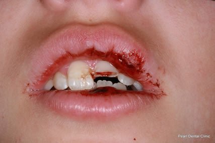 Cost and Psychological Effects of Tooth Injuries on Children
