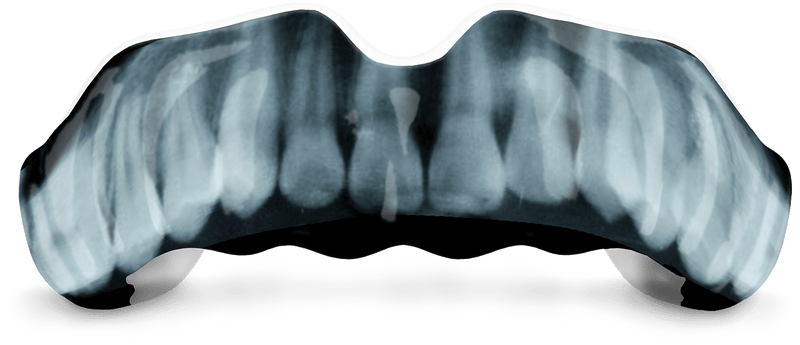 X-Ray Custom Mouthguard