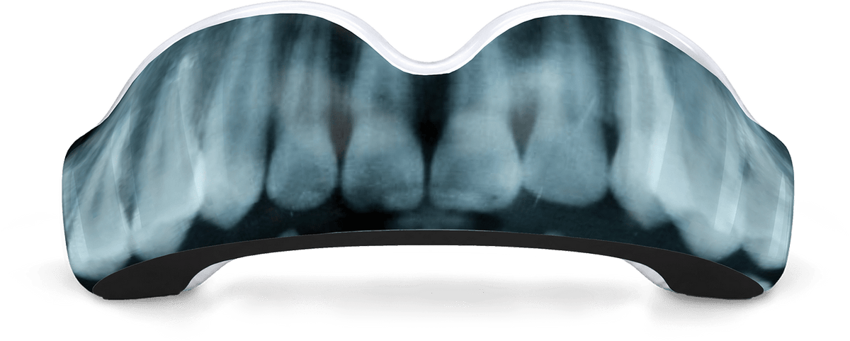 X-Ray Mouthguard (EI) - Damage Control Mouthguards